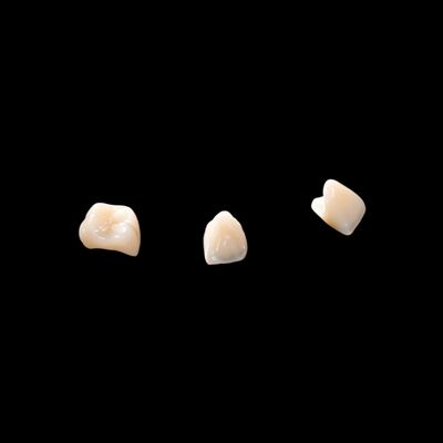 Porcelana CAD/CAM fundida com ponte de zircônio para restauração de aparência natural