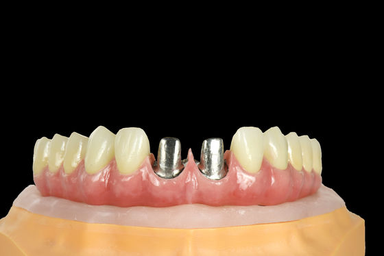 comprar FDA Titânio ponte implante dentário estrutura de titânio com coroa online manufacture