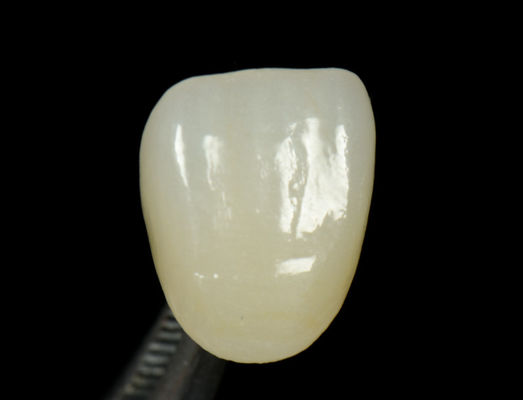 comprar Coroa de Prensa Emax Personalizável Rápida e Alta Estética Dental Inlay Onlay online manufacture