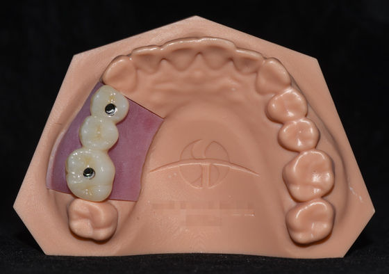 comprar Implante de porcelana fundida com zircônio Implante de ponte da coroa Altamente estética online manufacture