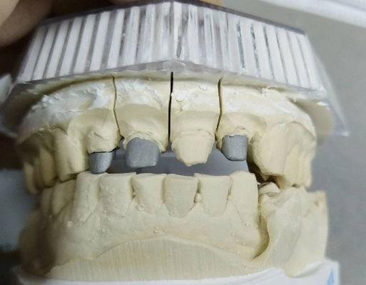 comprar Coroa e ponte de metal não precioso de pós-núcleo online manufacture
