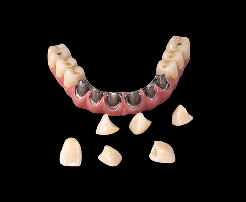 comprar Todos em X Implante Titânio Ponte Odontológico apenas Quadro Profissional online manufacture