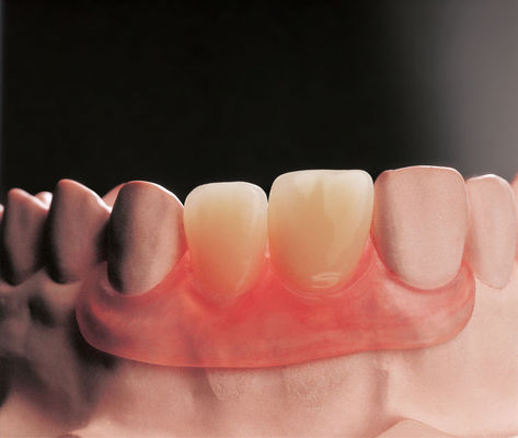 Dentaduras removíveis de barbatanas flexíveis Prótese parcial removível clínica