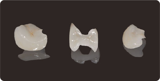 Precision Dental Inlays And Onlays Lítio Disilicate Moagem Onlay Veneer