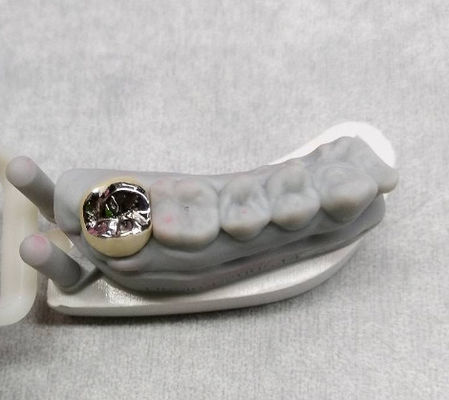 Coroa de metal de liga semi-preciosa e coroa temporária do dente de ponte