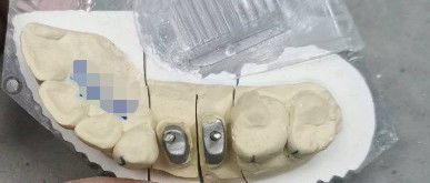 Coroas de Titânio para Dentes Metálicas / Naturais