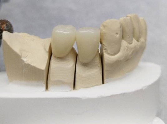 Coroa temporária dentária personalizada PMMA ponte temporária e coroa