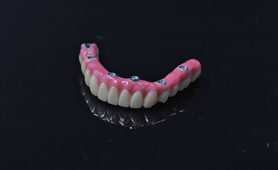 Implantação de dentaduras de carga imediata Dentes artificiais removíveis cor-de-rosa clara