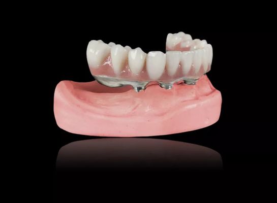 Implantes de barras de titânio Dentaduras removíveis Barras de titânio em ligação Dentaduras excessivas