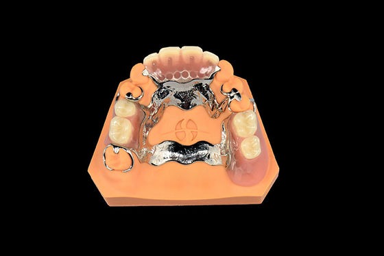 Implantes Dentários Dentes Removíveis Dentes Vitallium Metal Dentes Parciais