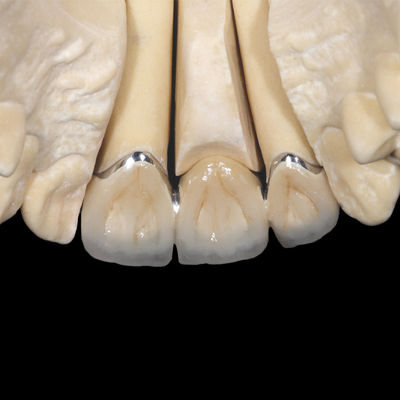 Implante de coroa PFM não precioso de porcelana fundida com coroa de metal