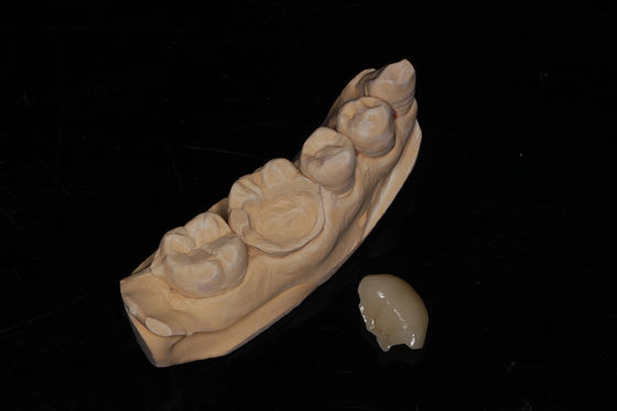 Dental Composite Onlay Veneer Alta estética Veneer composto