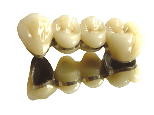 Coroa de metal de liga semi-preciosa e coroa temporária do dente de ponte