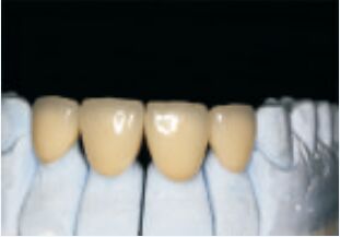 Coroa e ponte de alta nobreza de liga preciosa